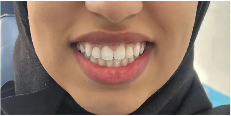 After treatment
