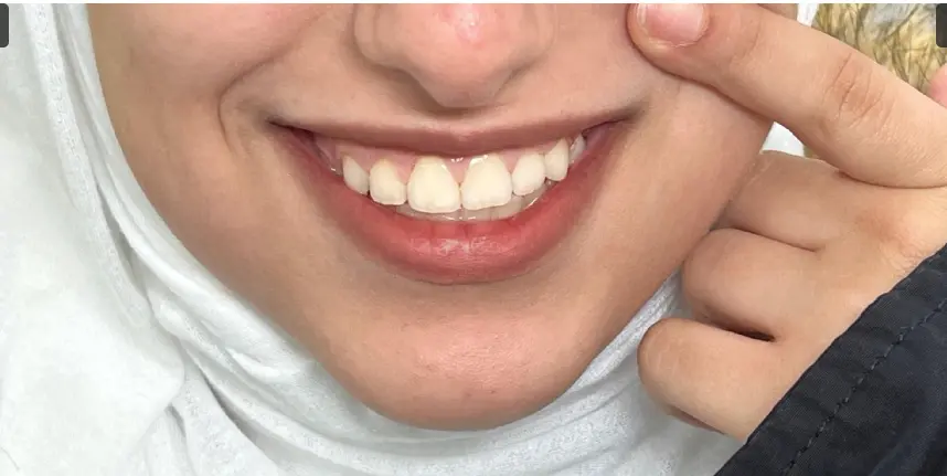 After treatment